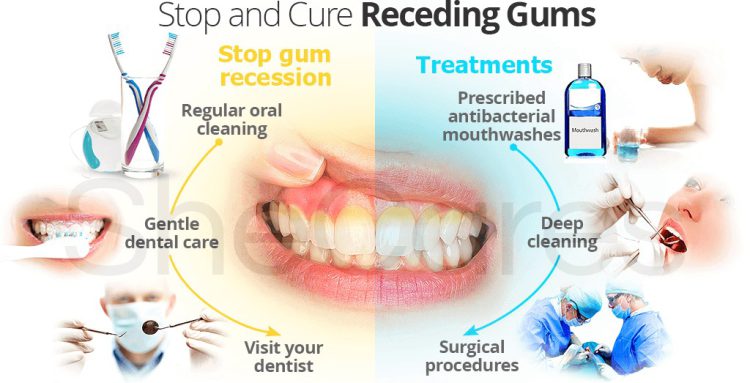 stop and cure receding gums 2