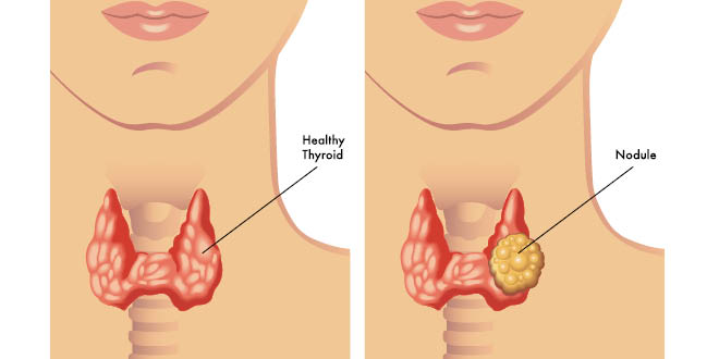 thyroid nodule w
