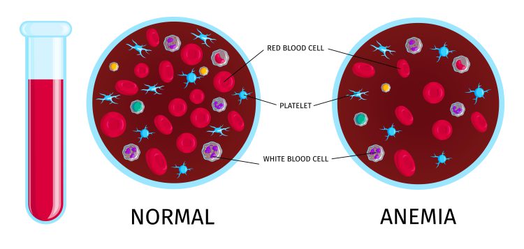 17714220 2012.i504.012.blood cells anemia 1