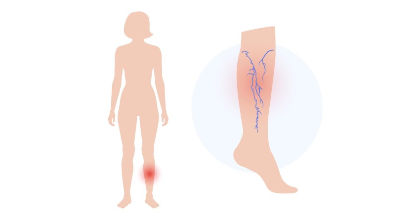 varicose veins treatment 206049 7026