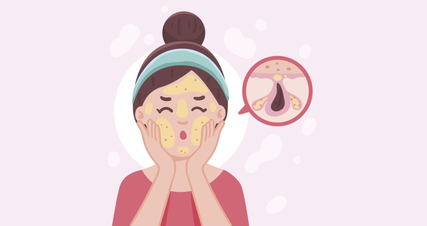 فواید کلیندامایسین برای آکنه
