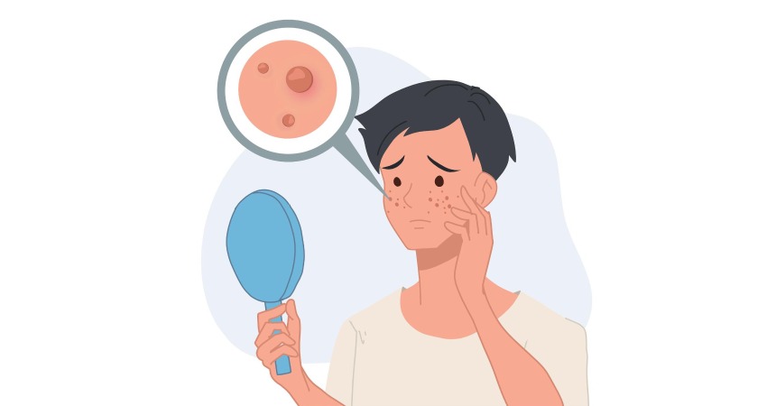از بین بردن جوش صورت در یک روز