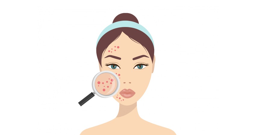 مزایای استفاده از سالیسیلیک اسید برای پوست