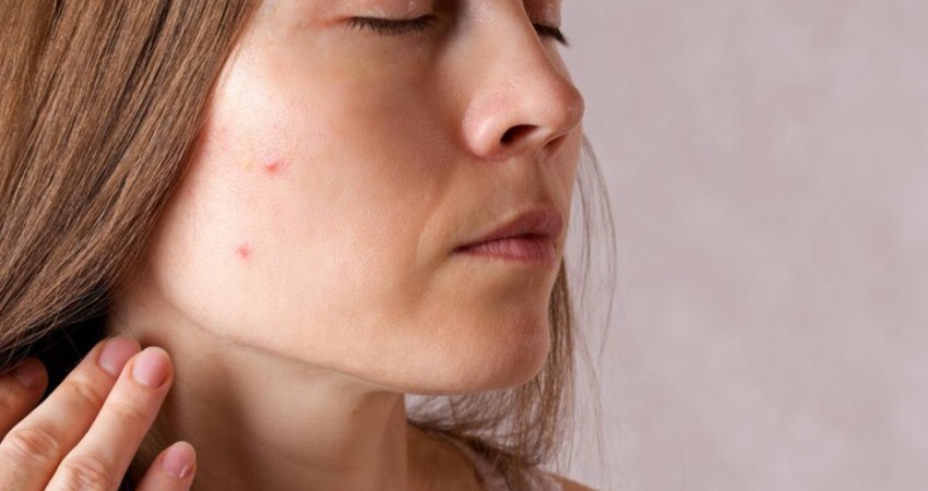 علت جوش صورت چیست؟ راههای سریع درمان آکنه و جای جوش 3 بهترین روش خانگی برای درمان جای جوش و لک آکنه
