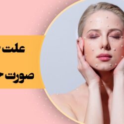 علت جوش صورت چیست؟